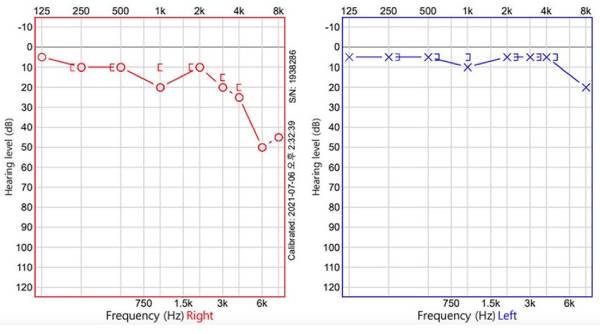 کاهش شنوایی