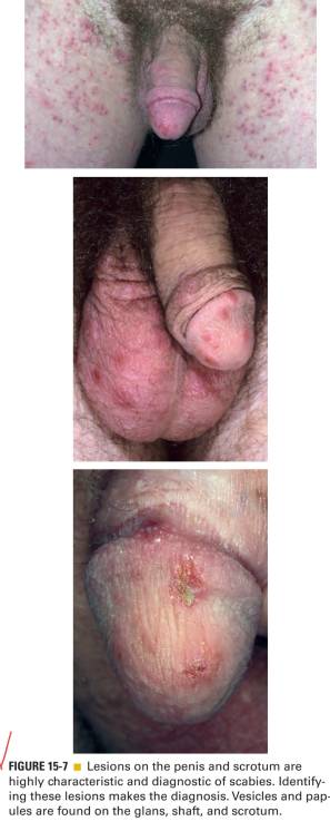 گال (scabies)