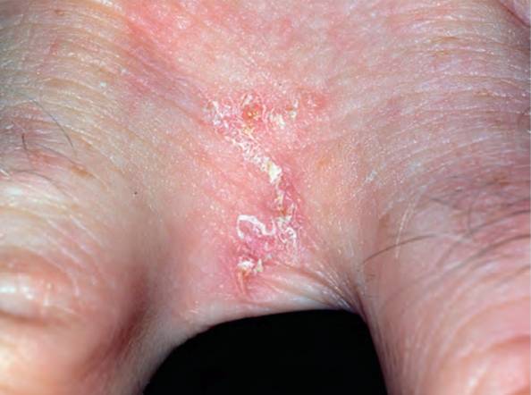 گال (scabies)