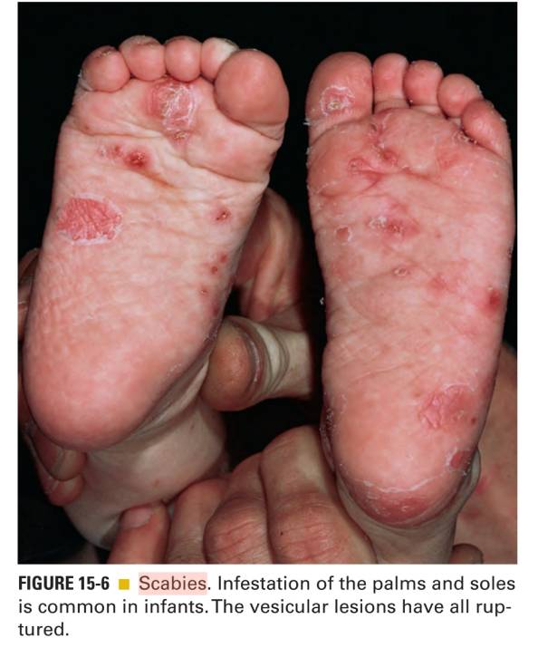 گال (scabies)