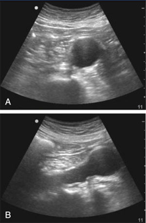 دایسکشن/آنوریسم آئورت