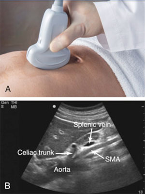 دایسکشن/آنوریسم آئورت