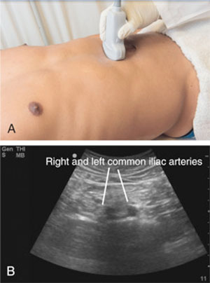 دایسکشن/آنوریسم آئورت