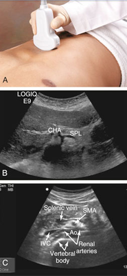 دایسکشن/آنوریسم آئورت