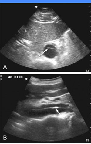 دایسکشن/آنوریسم آئورت